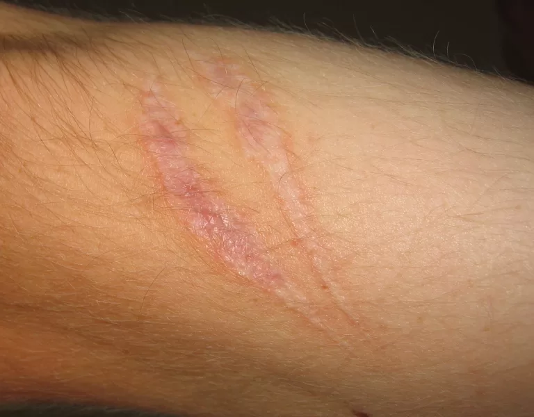 Scarring on the arm